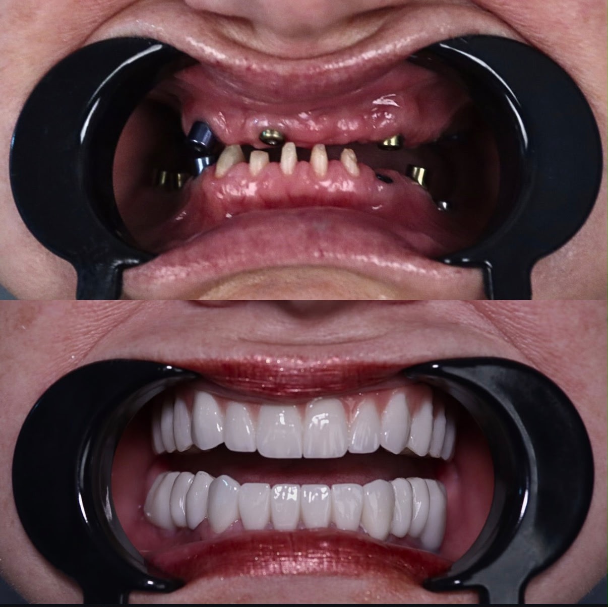 Dental Implants result – Patient 1 · Dr. Mervan Dental Clinic
