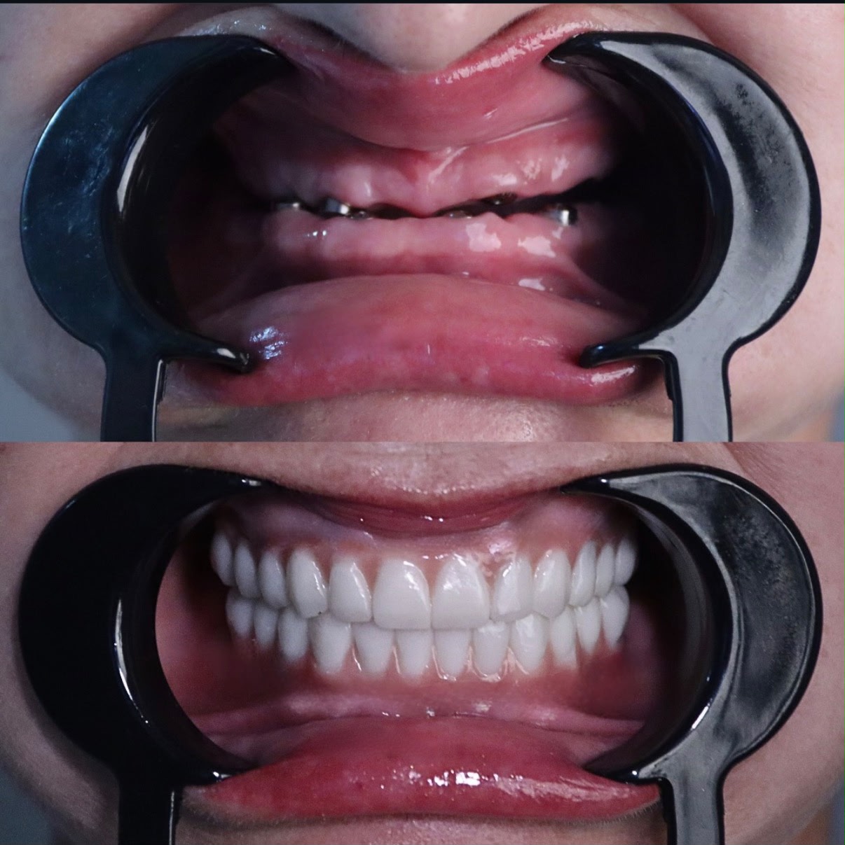 Dental Implants result – Patient 2 · Dr. Mervan Dental Clinic