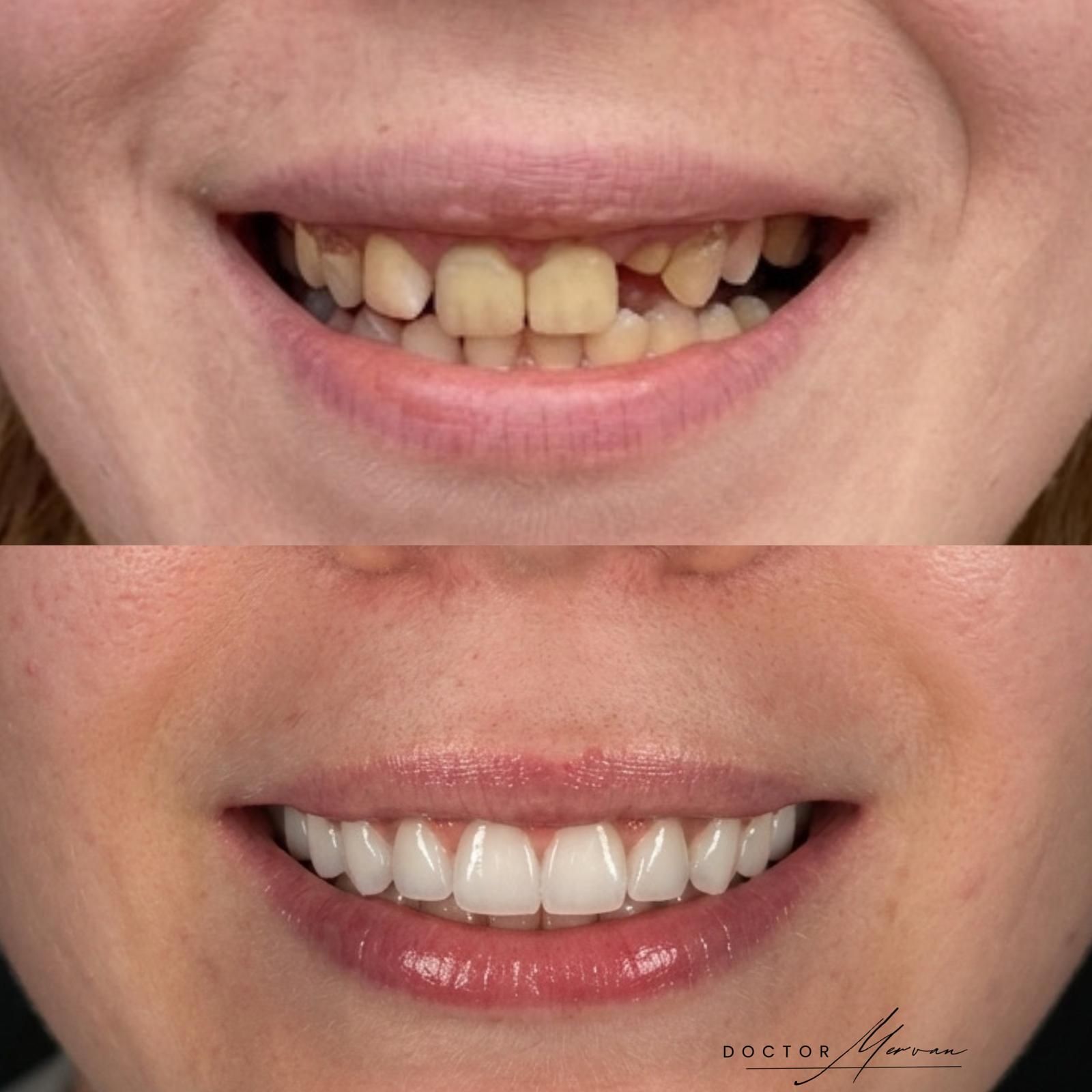 Laminate Veneers result – Patient 1 · Dr. Mervan Dental Clinic