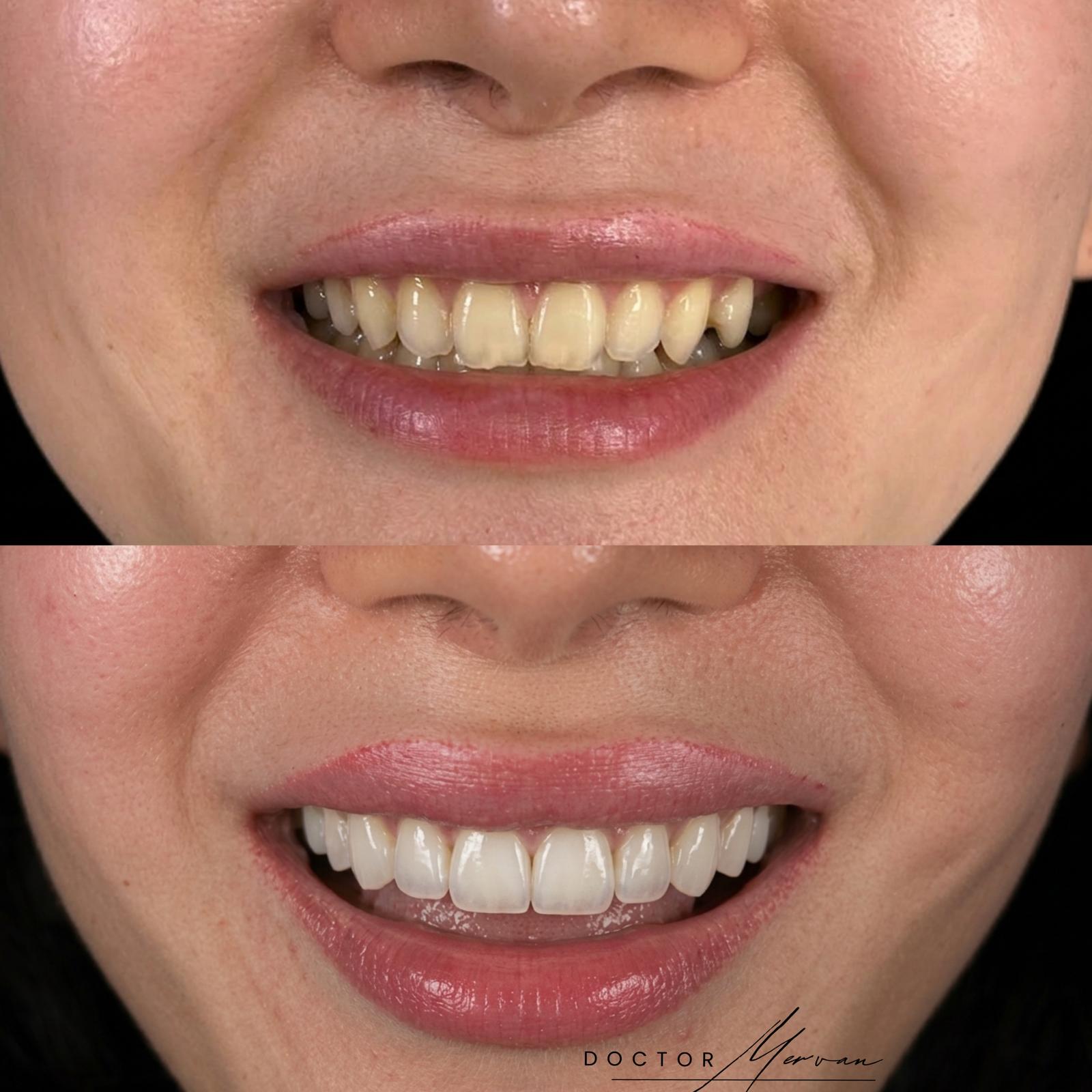 Laminate Veneers result – Patient 3 · Dr. Mervan Dental Clinic