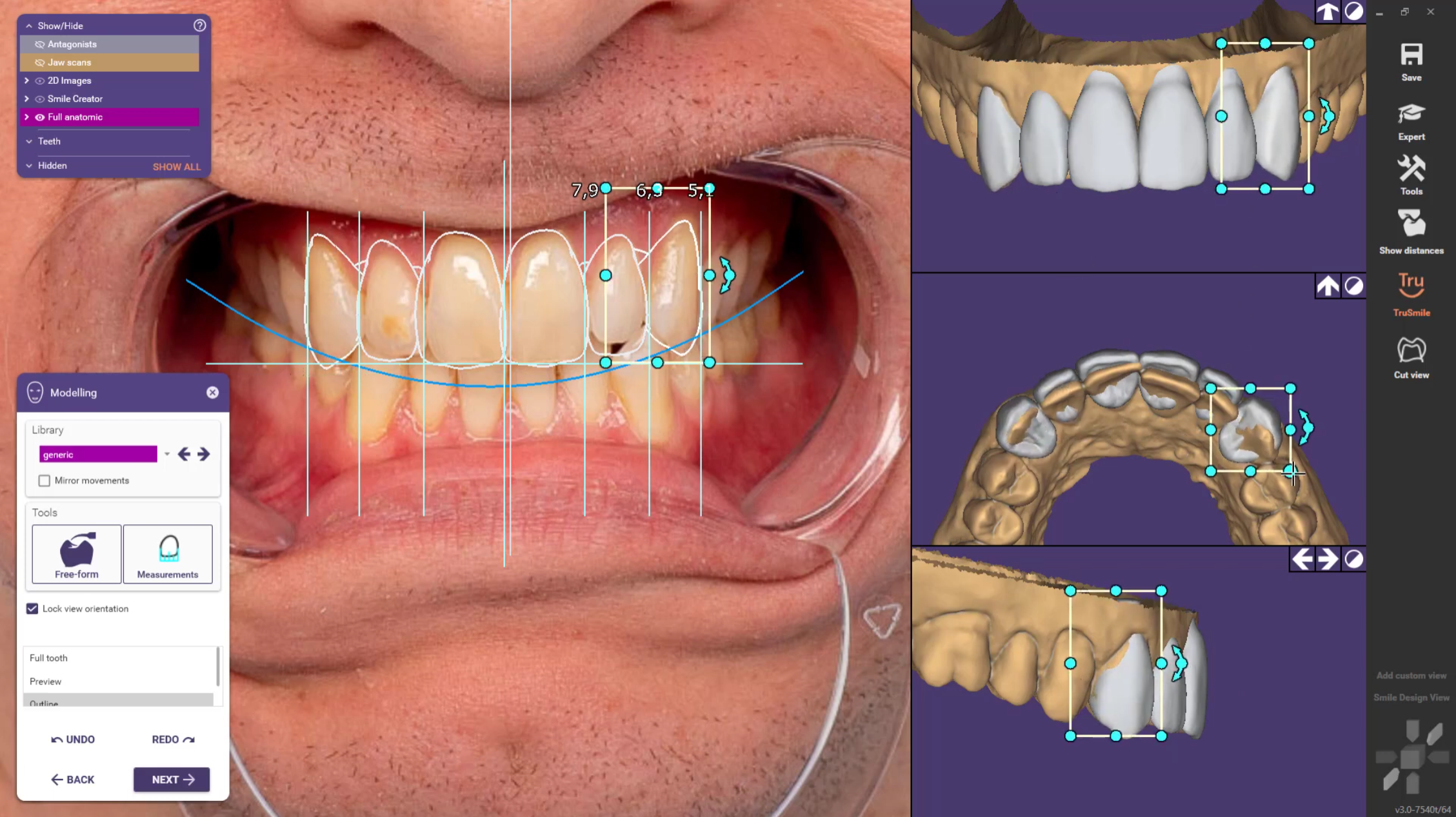 exocad Smile Modelling workflow — Dr. Mervan Dental Clinic