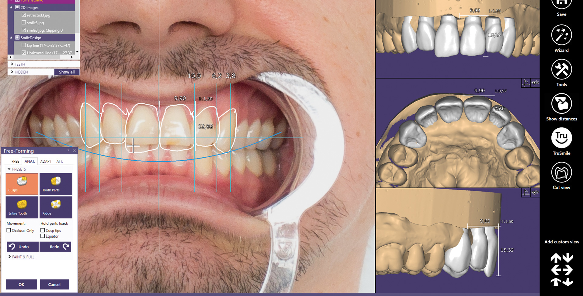 exocad Free-Forming tools — Dr. Mervan Dental Clinic
