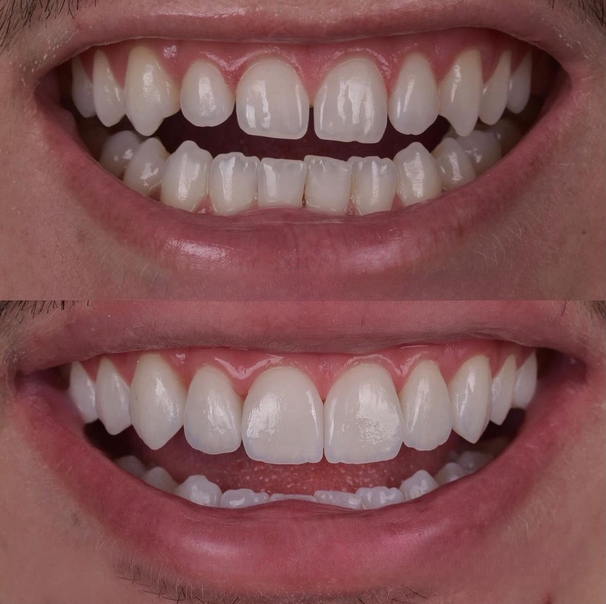 Zirconia Crowns result – Patient 1 · Dr. Mervan Dental Clinic