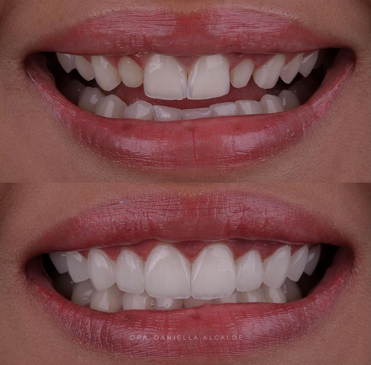 Zirconia Crowns result – Patient 2 · Dr. Mervan Dental Clinic